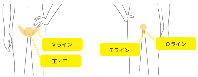 VIO脱毛の料金